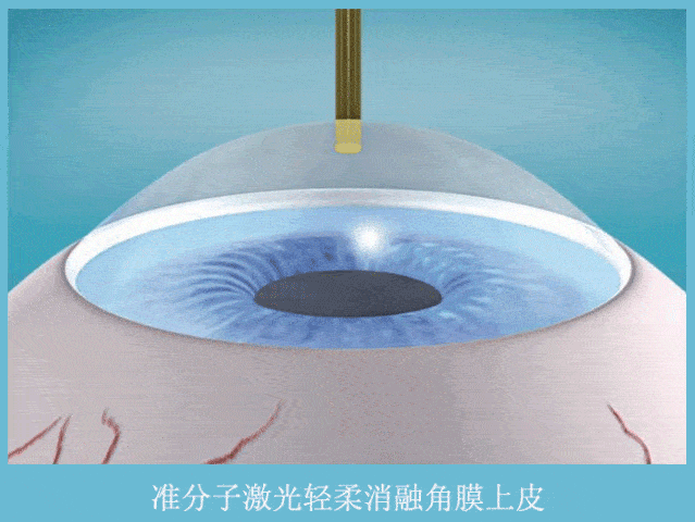 <strong>SMART全激光近视手术</strong>